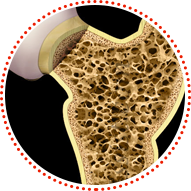 osteoporoz